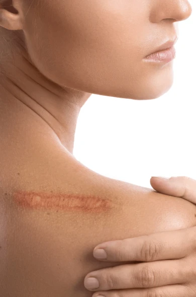 Non-Surgical Scar Treatment for Clear Skin