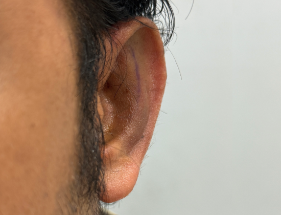 Otoplasty - Ear Pinning